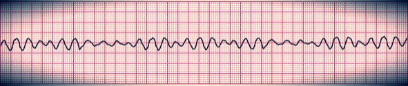 Ventricular Fibrillation - life threatening cardiac condition when external electrical defibrillation is the most successful treatment