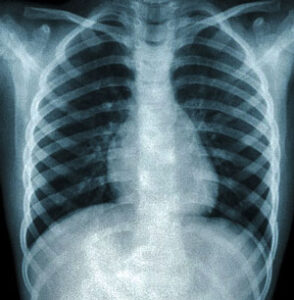 Pneumonia - infection of lungs that is treated with antibiotics and sometimes patients requires hospitalisation